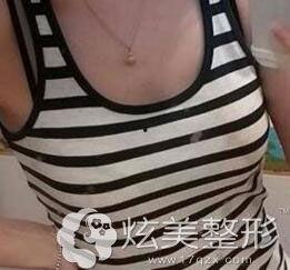 乳房干瘪下垂照片,照片背后的健康警示  第2张